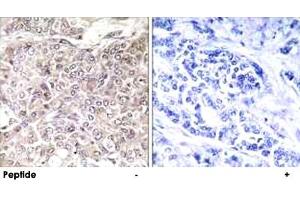 Immunohistochemistry analysis of paraffin-embedded human breast carcinoma tissue using GPRIN3 polyclonal antibody . (GPRIN3 Antikörper)