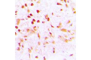 Immunohistochemical analysis of CDCA2 staining in human lung cancer formalin fixed paraffin embedded tissue section. (CDCA2 Antikörper  (Center))