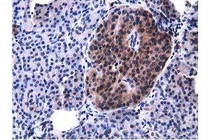 Immunohistochemical staining of paraffin-embedded Carcinoma of Human lung tissue using anti-VWA5A mouse monoclonal antibody. (VWA5A Antikörper)