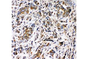 Anti-VRL1 antibody, IHC(P) IHC(P): Human Intestinal Cancer Tissue (TRPV2 Antikörper  (N-Term))