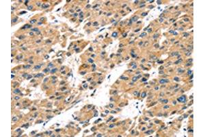 The image on the left is immunohistochemistry of paraffin-embedded Human liver cancer tissue using ABIN7192934(TRPV5 Antibody) at dilution 1/25, on the right is treated with synthetic peptide. (TRPV5 Antikörper)