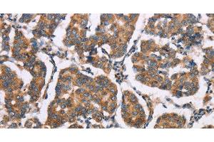 Immunohistochemistry of paraffin-embedded Human breast cancer tissue using ELP3 Polyclonal Antibody at dilution of 1:35 (ELP3/KAT9 Antikörper)