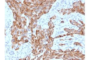 Formalin-fixed, paraffin-embedded human Lung Carcinoma stained with Cytokeratin-7 Mouse Monoclonal Antibody (KRT7/2200). (Cytokeratin 7 Antikörper)