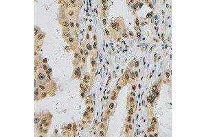Immunohistochemical analysis of TBX1 staining in human lung cancer formalin fixed paraffin embedded tissue section. (T-Box 1 Antikörper  (C-Term))