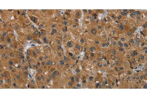 Immunohistochemistry of paraffin-embedded Human liver cancer using HSD3B7 Polyclonal Antibody at dilution of 1:40