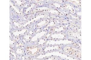 ABIN6267506 at 1/100 staining human kidney carcinoma tissue sections by IHC-P. (HNF4A Antikörper  (pSer313))