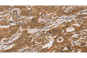 Immunohistochemistry of paraffin-embedded Human gastric cancer tissue using CYP17A1 Polyclonal Antibody at dilution 1:30 (CYP17A1 Antikörper)