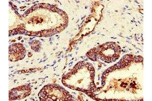Immunohistochemistry of paraffin-embedded human prostate cancer using ABIN7154428 at dilution of 1:100 (FAM59A Antikörper  (AA 12-320))