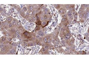 ABIN6276632 at 1/100 staining Human liver cancer tissue by IHC-P. (CD236/GYPC Antikörper  (Internal Region))