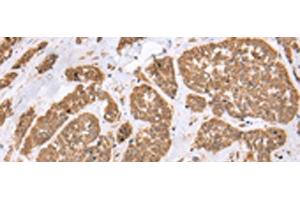 Immunohistochemistry of paraffin-embedded Human esophagus cancer tissue using E2F5 Polyclonal Antibody at dilution of 1:25(x200) (E2F5 Antikörper)