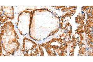 Immunohistochemistry of paraffin-embedded Human thyroid cancer tissue using ACOX1 Polyclonal Antibody at dilution 1:40 (ACOX1 Antikörper)