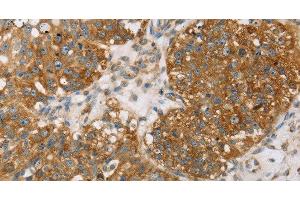 Immunohistochemistry of paraffin-embedded Human breast cancer using TPD54 Polyclonal Antibody at dilution of 1:35