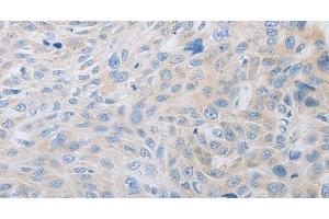 Immunohistochemistry of paraffin-embedded Human esophagus cancer using PDX1 Polyclonal Antibody at dilution of 1:30 (PDX1 Antikörper)