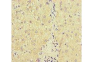 Immunohistochemistry of paraffin-embedded human liver cancer using ABIN7167234 at dilution of 1:100