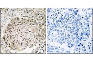 Immunohistochemistry analysis of paraffin-embedded human lung carcinoma, using USP36 Antibody. (USP36 Antikörper  (AA 501-550))
