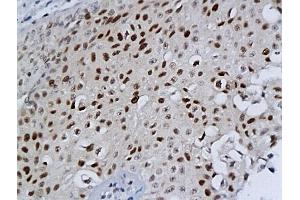 Formalin-fixed and paraffin embedded bladder cancer labeled with Anti-MCM-2 Polyclonal Antibody, Unconjugated (ABIN676238) at 1:200 followed by conjugation to the secondary antibody and DAB staining (MCM2 Antikörper  (AA 601-700))