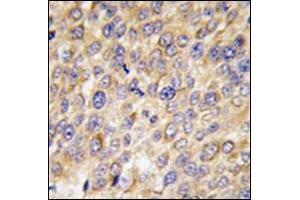 Formalin-Fixed, Paraffin-Embedded human hepatocarcinoma tissue reacted with Autophagy GABARAP Antibody (N-term) followed which was peroxidase-conjugated to the secondary antibody, followed by DAB staining. (GABARAP Antikörper  (N-Term))