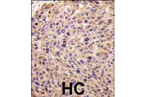Formalin-fixed and paraffin-embedded human hepatocarcinoma tissue reacted with GGPS1 Antibody (N-term), which was peroxidase-conjugated to the secondary antibody, followed by DAB staining. (GGPS1 Antikörper  (N-Term))