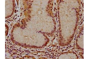 IHC image of ABIN7156557 diluted at 1:100 and staining in paraffin-embedded human gastric cancer performed on a Leica BondTM system. (IFNA16 Antikörper  (AA 24-189))