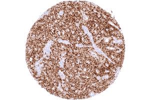 Serous high grade ovarian carcinoma with strong PAX8 staining of tumor cells (Rekombinanter PAX8 Antikörper)