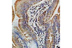 Immunohistochemical analysis of COX6B1 staining in human colon cancer formalin fixed paraffin embedded tissue section. (COX6B1 Antikörper)