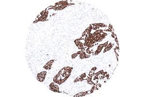Strong cytokeratin 13 immunostaining in a squamous cell carcinoma of the oral cavity (Cytokeratin 13 Antikörper)