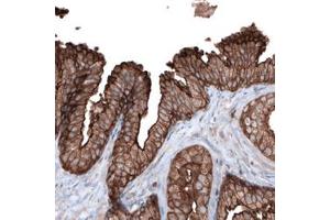 Immunohistochemical staining (Formalin-fixed paraffin-embedded sections) of human prostate cancer with EZR monoclonal antibody, clone CL2384  shows strong membranous and moderate cytoplasmic positivity in glandular cells. (Ezrin Antikörper)