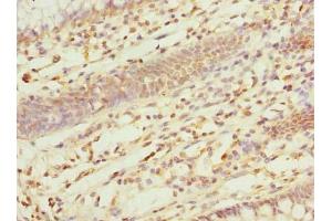 Immunohistochemistry of paraffin-embedded human colon cancer using ABIN7162554 at dilution of 1:100 (ZDHHC5 Antikörper  (AA 231-500))