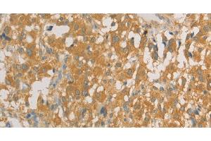 Immunohistochemistry of paraffin-embedded Human thyroid cancer tissue using PRPSAP1 Polyclonal Antibody at dilution 1:80 (PRPSAP1 Antikörper)