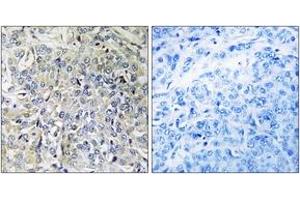 Immunohistochemistry analysis of paraffin-embedded human breast carcinoma tissue, using CSGALNACT2 Antibody.