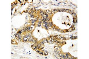 Anti-Annexin A3 antibody, IHC(P) IHC(P): Human Mammary Cancer Tissue (Annexin A3 Antikörper  (Middle Region))