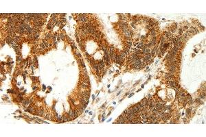 Immunohistochemistry of paraffin-embedded Human colon cancer using COX7B Polyclonal Antibody at dilution of 1:60 (COX7B Antikörper)