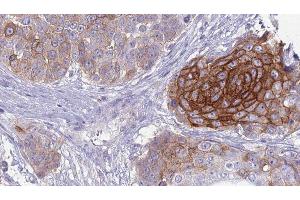 ABIN6279126 at 1/100 staining Human urothelial cancer tissue by IHC-P. (SLC4A2 Antikörper  (Internal Region))