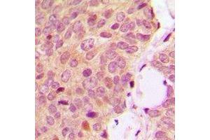 Immunohistochemical analysis of OMI staining in human breast cancer formalin fixed paraffin embedded tissue section.