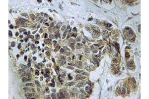 Immunohistochemistry analyzes of Caspase 9 antibody in paraffin-embedded human lung carcinoma tissue. (Caspase 9 Antikörper)