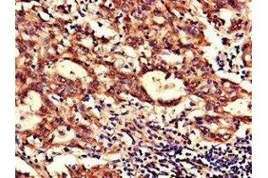 Immunohistochemistry of paraffin-embedded human lung cancer using ABIN7160929 at dilution of 1:100 (NDUFB6 Antikörper  (AA 2-67))