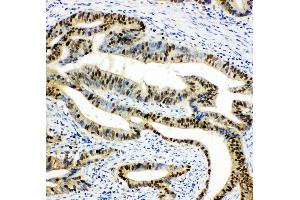 Anti-DUT antibody,  IHC(P) IHC(P): Human Intestinal Cancer Tissue (Deoxyuridine Triphosphatase (DUT) (AA 212-229), (C-Term) Antikörper)
