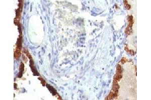 Formalin-fixed, paraffin-embedded human lung carcinoma stained with Cytokeratin 7 antibody (KRT7/760) (Cytokeratin 7 Antikörper)