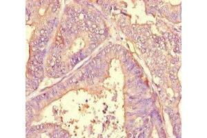 Immunohistochemistry of paraffin-embedded human endometrial cancer using ABIN7143790 at dilution of 1:100 (alpha 2 Macroglobulin Antikörper  (AA 1216-1467))