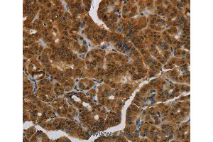 Immunohistochemistry of Human breast cancer using MRE11A Polyclonal Antibody at dilution of 1:60 (Mre11 Antikörper)