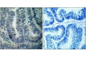 Immunohistochemistry analysis of paraffin-embedded human colon carcinoma tissue, using BAD (Ab-112) Antibody. (BAD Antikörper  (AA 78-127))