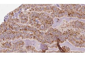 ABIN6273318 at 1/100 staining Human thyroid cancer tissue by IHC-P. (SHMT1 Antikörper  (Internal Region))