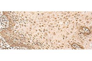 Immunohistochemistry of paraffin-embedded Human esophagus cancer tissue using BAP1 Polyclonal Antibody at dilution of 1:35(x200) (BAP1 Antikörper)