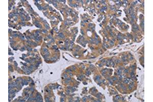 The image on the left is immunohistochemistry of paraffin-embedded Human ovarian cancer tissue using ABIN7191790(PARP4 Antibody) at dilution 1/20, on the right is treated with synthetic peptide. (PARP4 Antikörper)