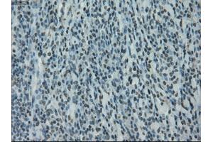 Immunohistochemical staining of paraffin-embedded Carcinoma of bladder tissue using anti-PRKYmouse monoclonal antibody. (PRKY Antikörper)