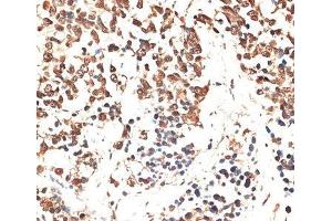 Immunohistochemistry of paraffin-embedded Human lung cancer using MCM5 Polyclonal Antibody at dilution of 1:100 (40x lens). (MCM5 Antikörper)