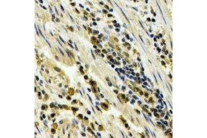 Immunohistochemical analysis of STAU1 staining in human esophageal cancer formalin fixed paraffin embedded tissue section. (STAU1/Staufen Antikörper)
