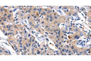Immunohistochemistry of paraffin-embedded Human lung cancer tissue using MMP16 Polyclonal Antibody at dilution 1:40 (MMP16 Antikörper)