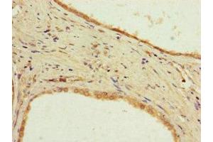 Immunohistochemistry of paraffin-embedded human prostate cancer using ABIN7169250 at dilution of 1:100