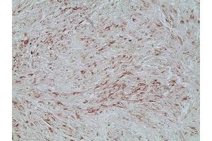 Immunohistochemistry analysis of human melanoma skin tissue using Melanoma marker (human) mAb (HMB45) (Ready-To-Use), (ABIN7211671).
